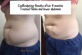 Before and after Coolsculpting treatment 1 session  by Medical Cosmetic Enhancementsin Washington DC